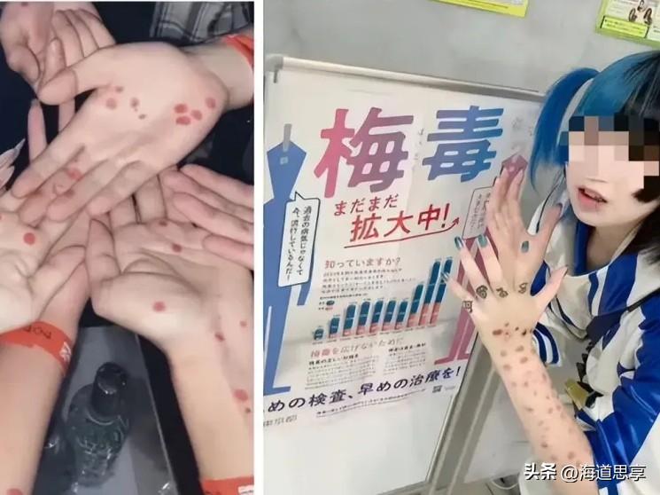 12年涨10倍，救命药都断货，日本年轻人居然把“晒梅毒”当潮酷？

不是段子，是