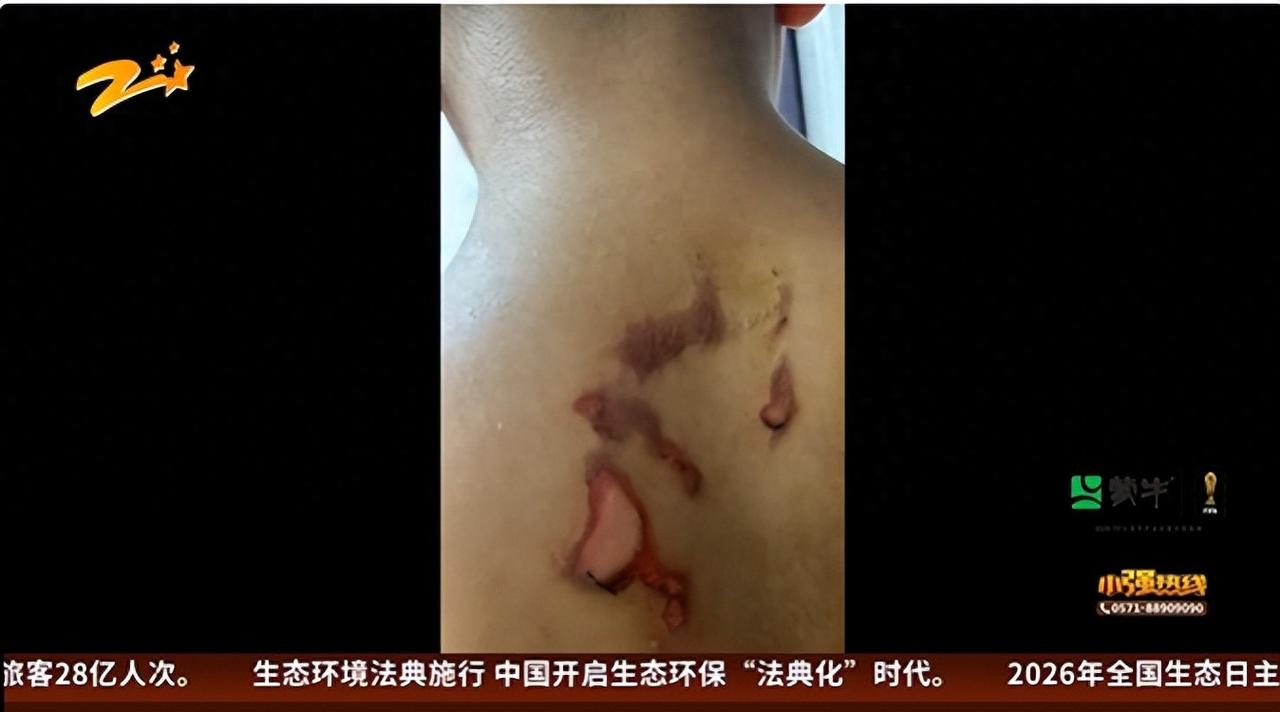 带孩子做针灸祛湿，却留下永久性疤痕，浙江一6岁男孩在医院针灸遭烫伤；家属：像火烧