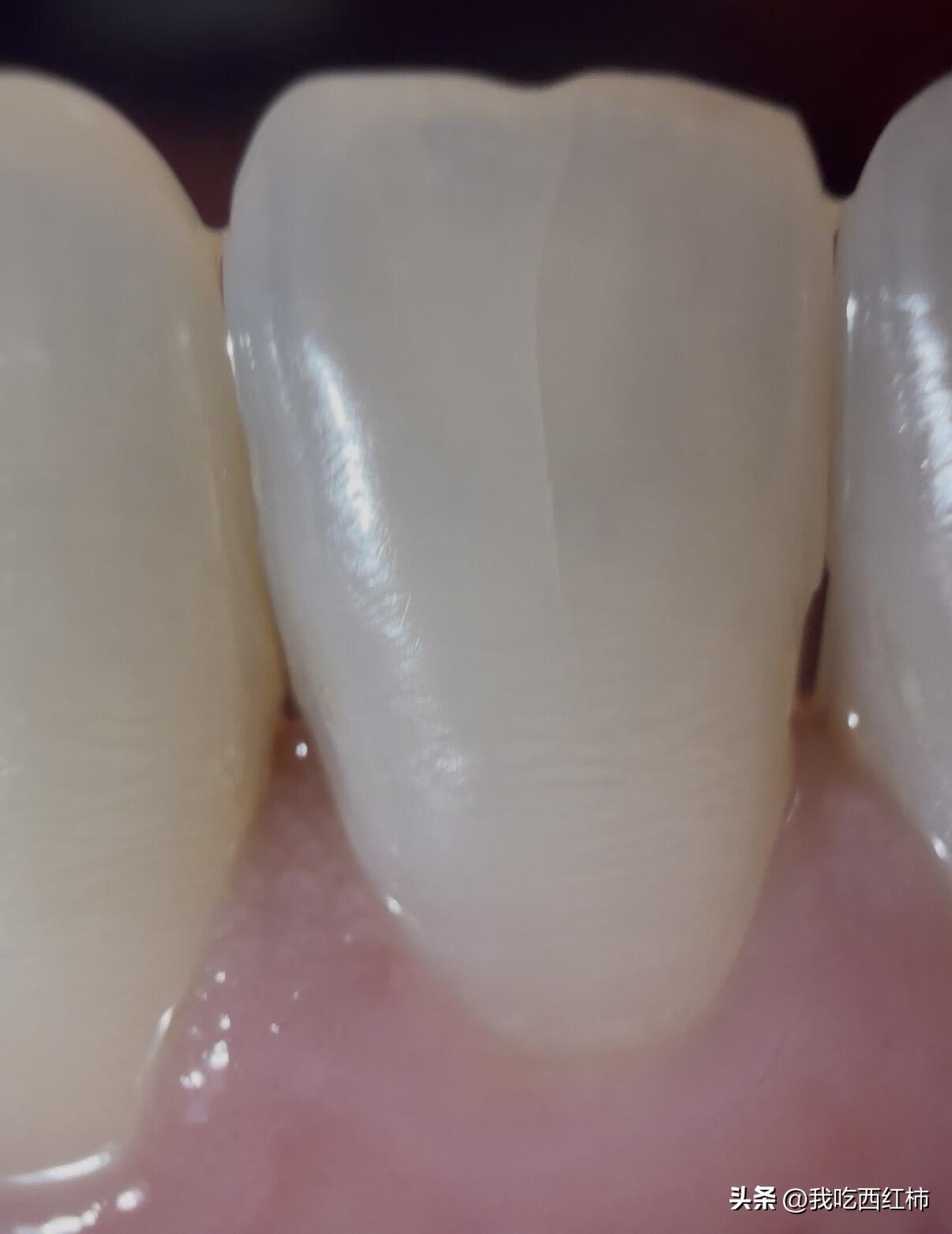 洗完牙发现多了裂纹
昨天下午去家附近口腔洗牙，洗的时候感觉有点酸痛但是还能接受的