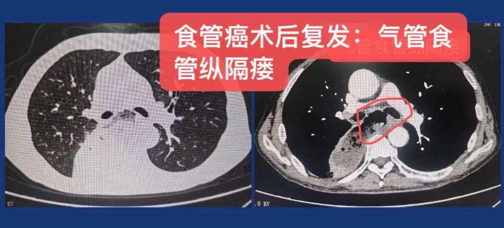食管癌穿孔、气管瘘的外科补救！食管癌放化疗后食管癌穿孔并纵隔、肺瘘！患...