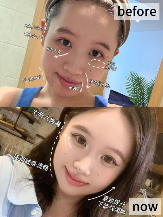 紫外线也会导致垮脸？？微调救急有用嘛