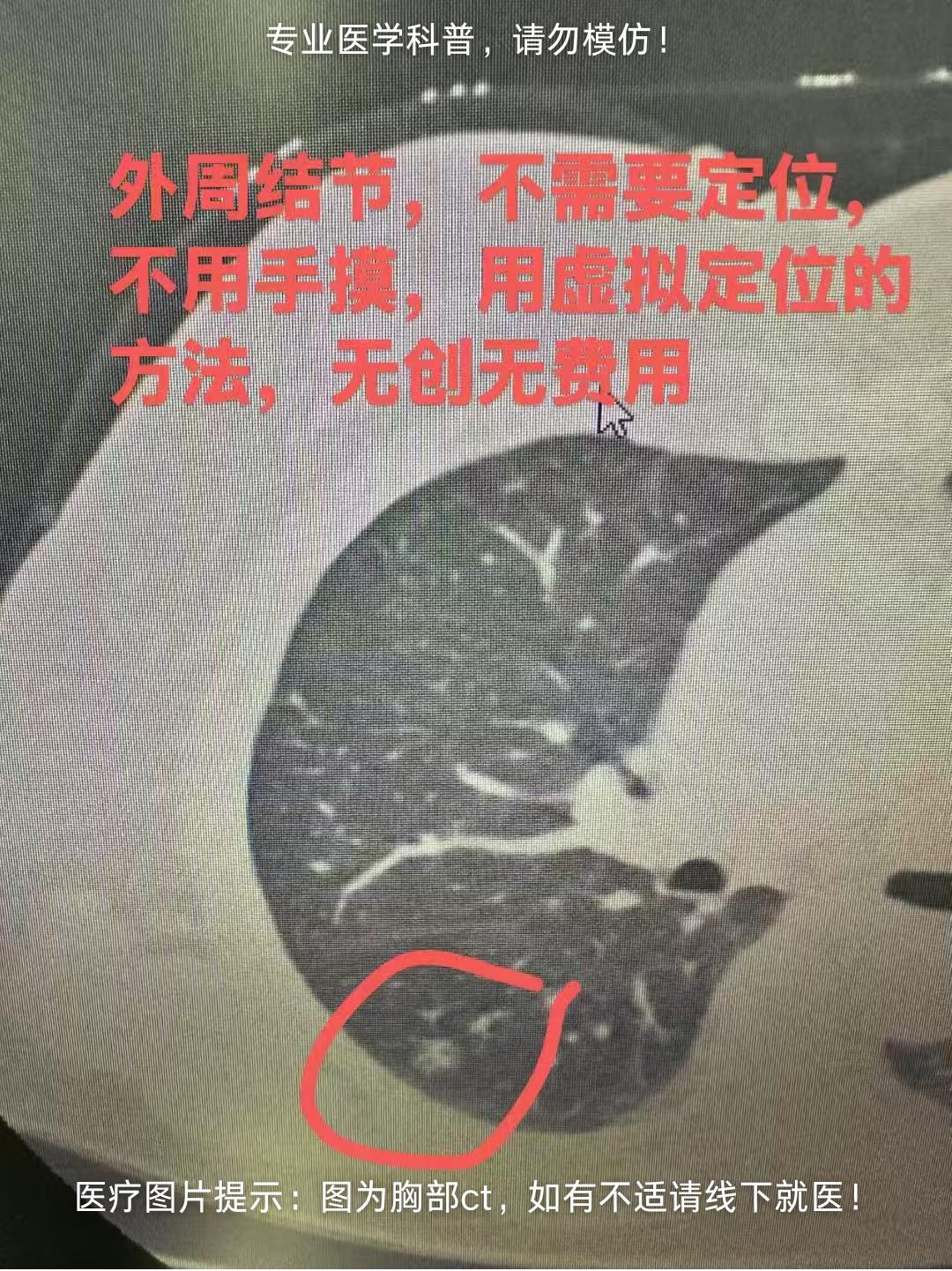 对于早期病变，我们如何能把手术做到极致？这个病变和病人不适合做经乳晕...