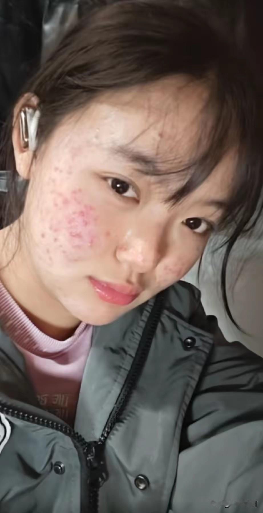 虽然一脸的青春痘，但也掩饰了她美颜如花的脸蛋！