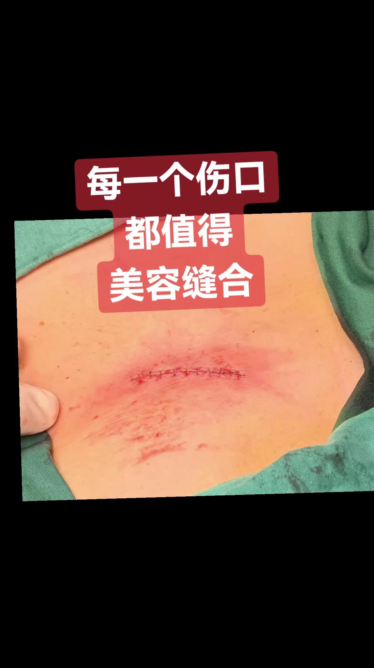 美容缝合适合每个伤口。不少疾病需要手术治疗 然后，手术附带的疤痕将一辈...