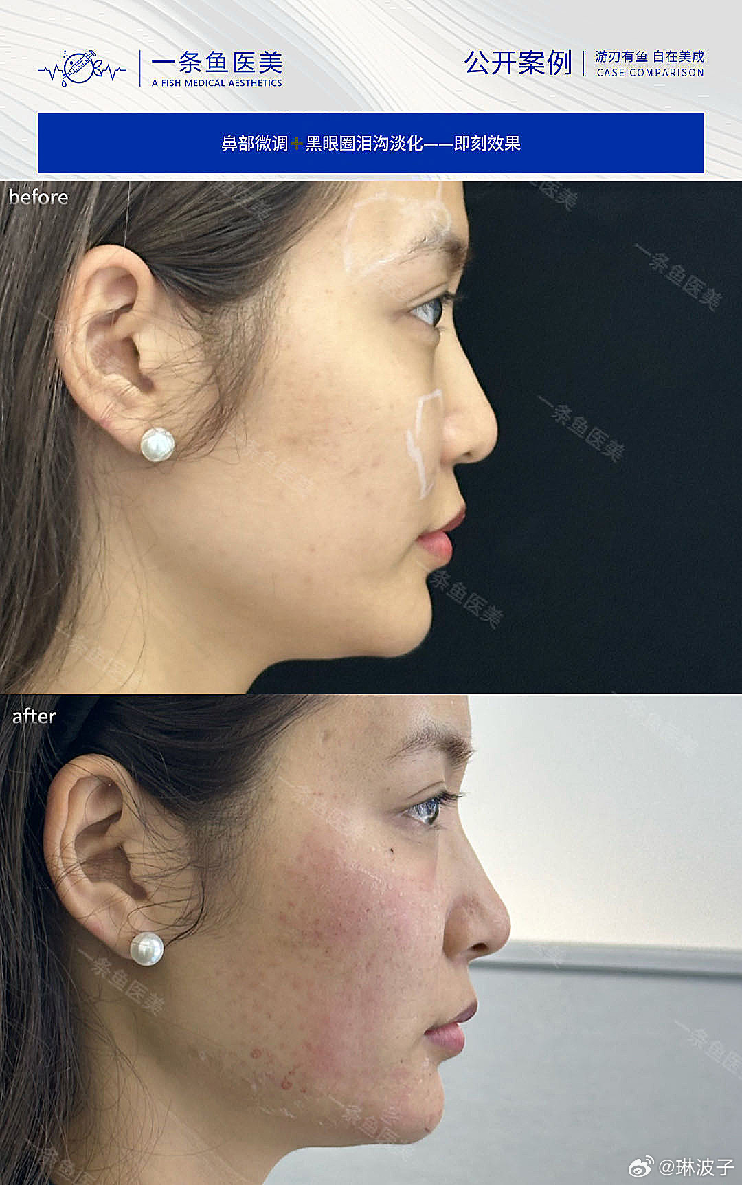 琳波医美 一些新案例～ ​​​
