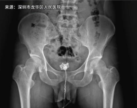 好奇害死猫一点也不假！广东深圳，一男子由于一时好奇，竟然把一根25厘米长的数据线