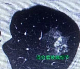 看到网上说“肺混合磨玻璃结节最危险”，很多朋友一查出就慌了，恨不得马上手术，其实