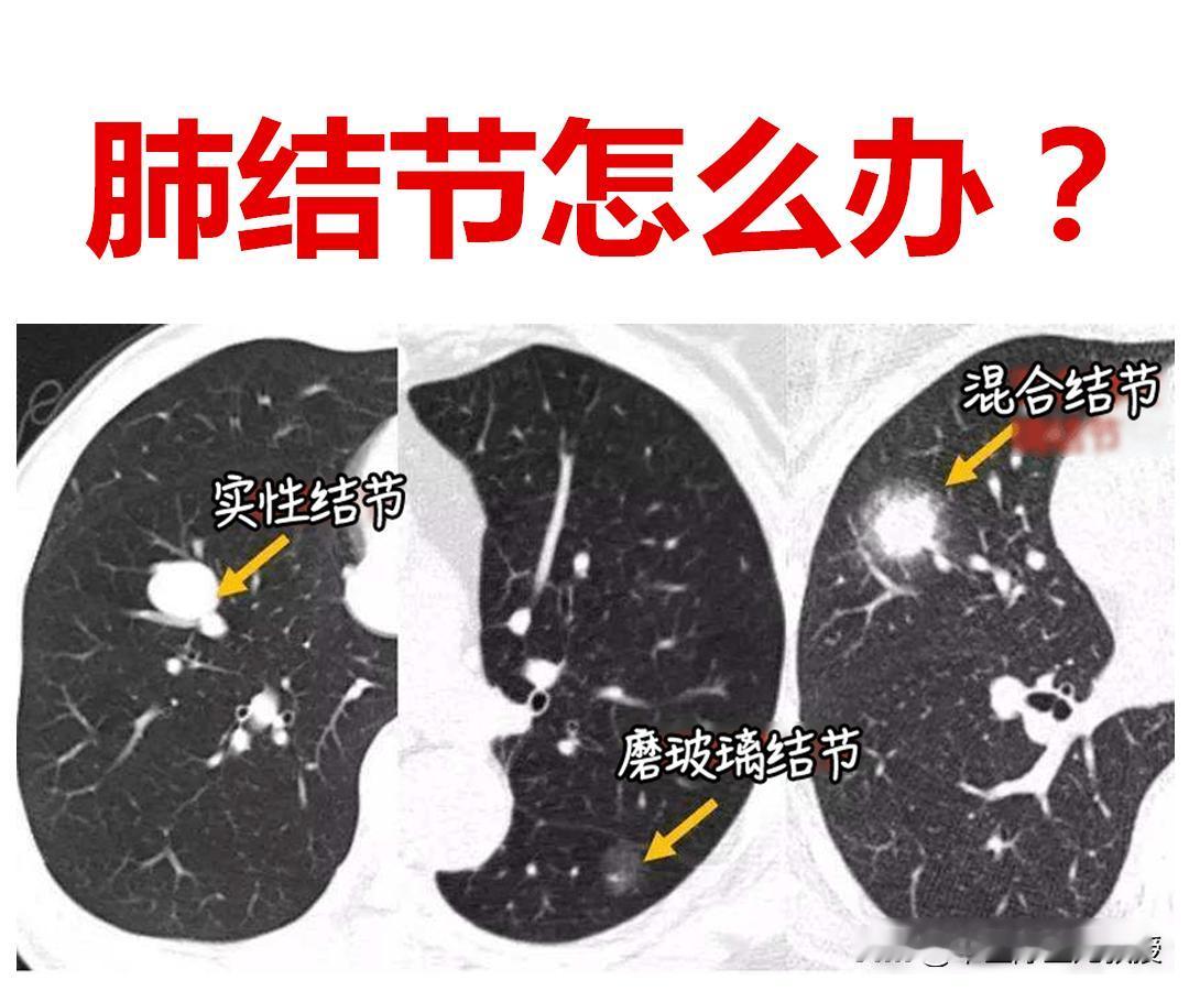 体检查出肺结节怎么办？不用怕，一文给你指明方向！中医肺结节[超话]