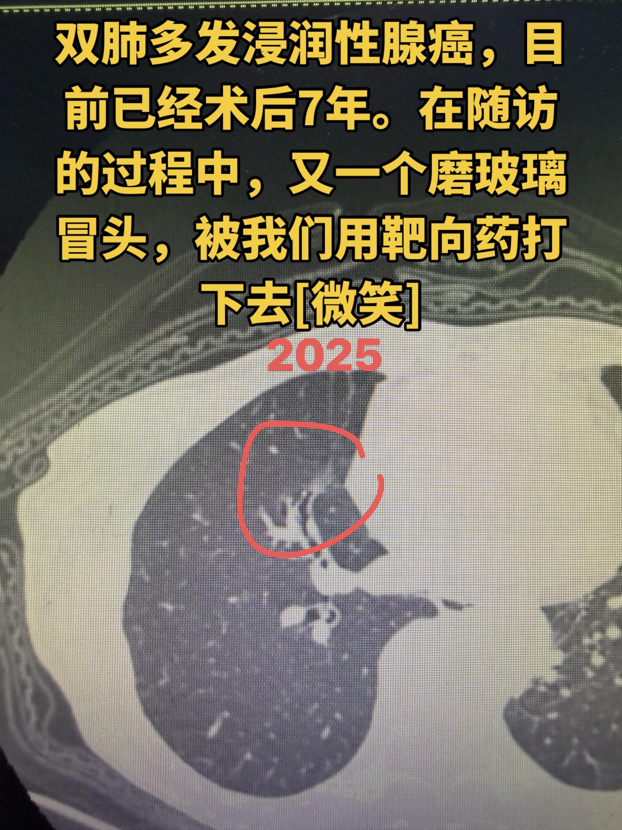 靶向药可以让部分磨玻璃缩小。的确，我们也观察到，靶向药可以让部分磨玻璃...