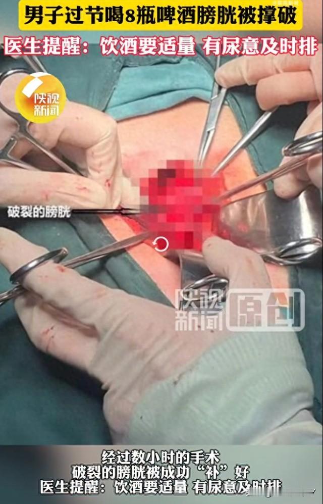 男子狂饮8瓶啤酒后，膀胱撑出6cm破口！医生警告要记牢
 
陕西西安的王先生和朋