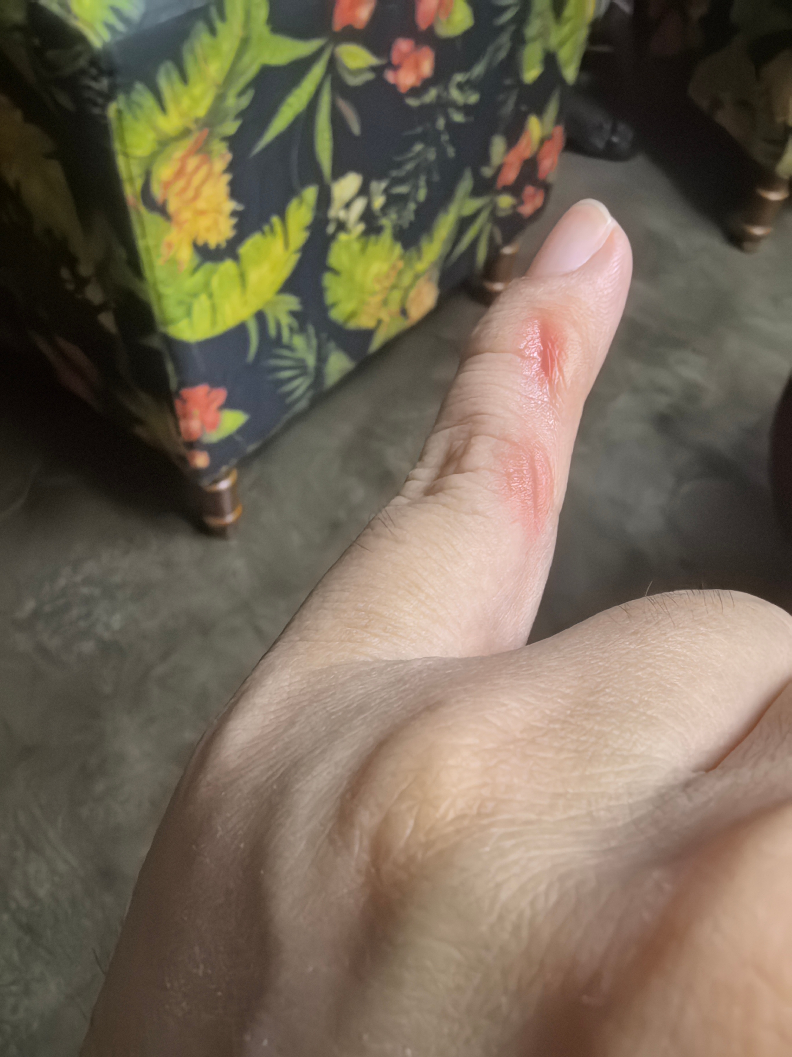 由于长时间刷微博…我的小拇指已经变形了…你们经常玩手机吗？手指头变形没？ 