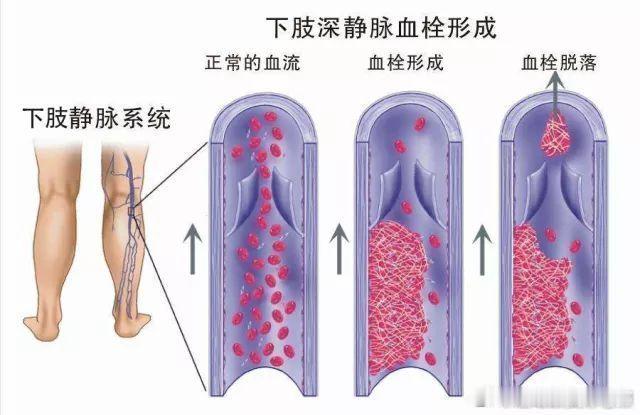 男子连续开车10小时到杭州差点截肢  其实类似的新闻之前有过好几条了，长时间坐飞