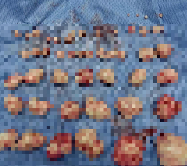 【#女子体内取出50颗重6斤子宫肌瘤#】#医生回应体内取出50颗重6斤子宫肌瘤#