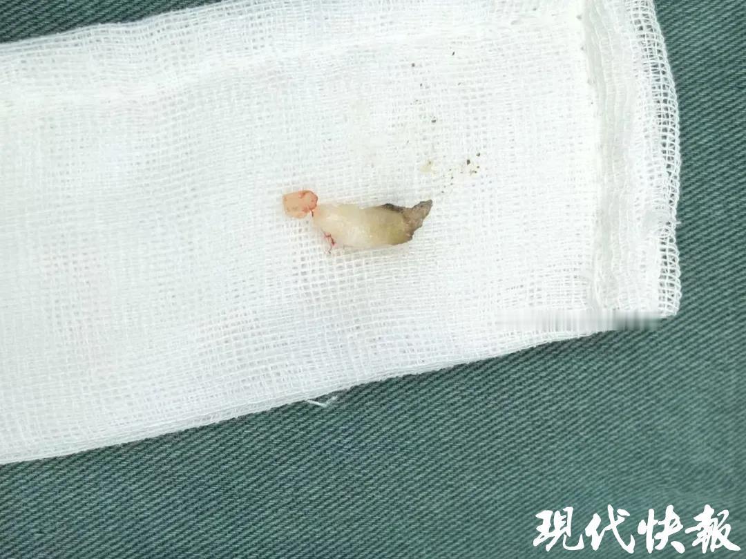 “换牙期惊魂！”7月8日报道，江苏扬州，一8岁女孩换牙期总喊鼻子疼，父母当鼻炎治