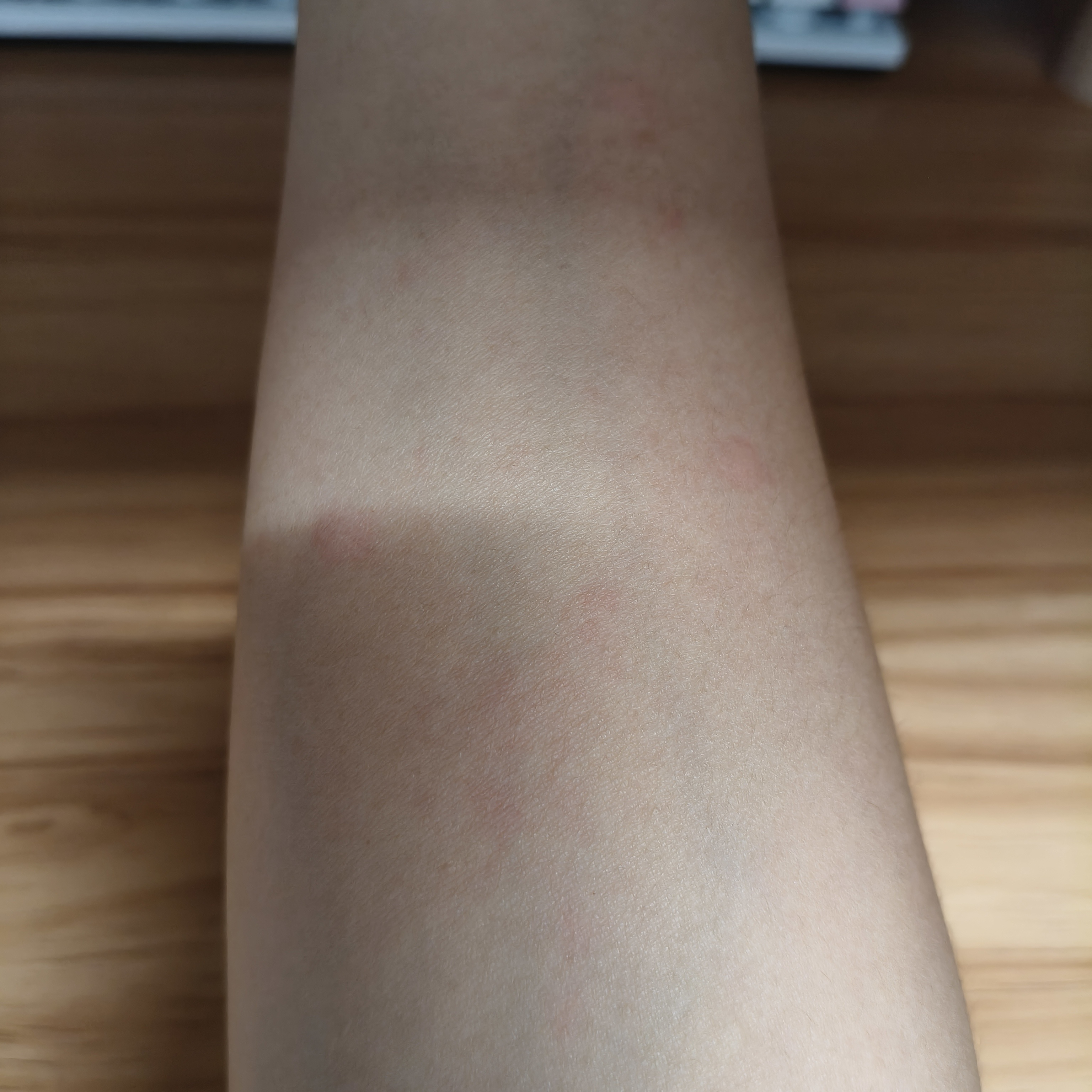 这玩意儿是啥啊，全身上下都好痒啊，还时不时冒出来几个，现在我额头上都开始痒了 ​
