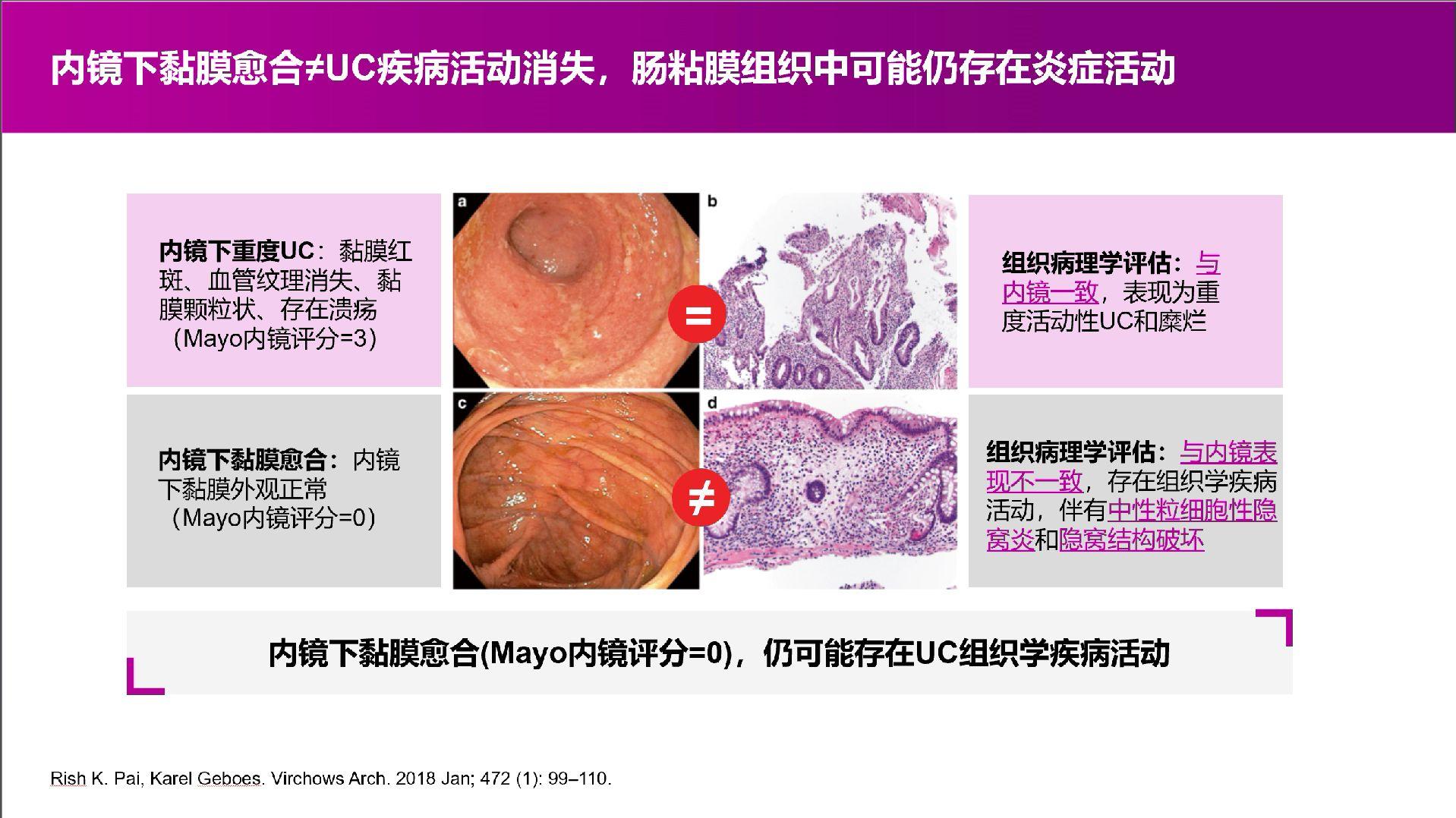 溃疡性结肠炎患者肠镜黏膜愈合也还是不够的。对于溃疡性结肠炎2024的最...