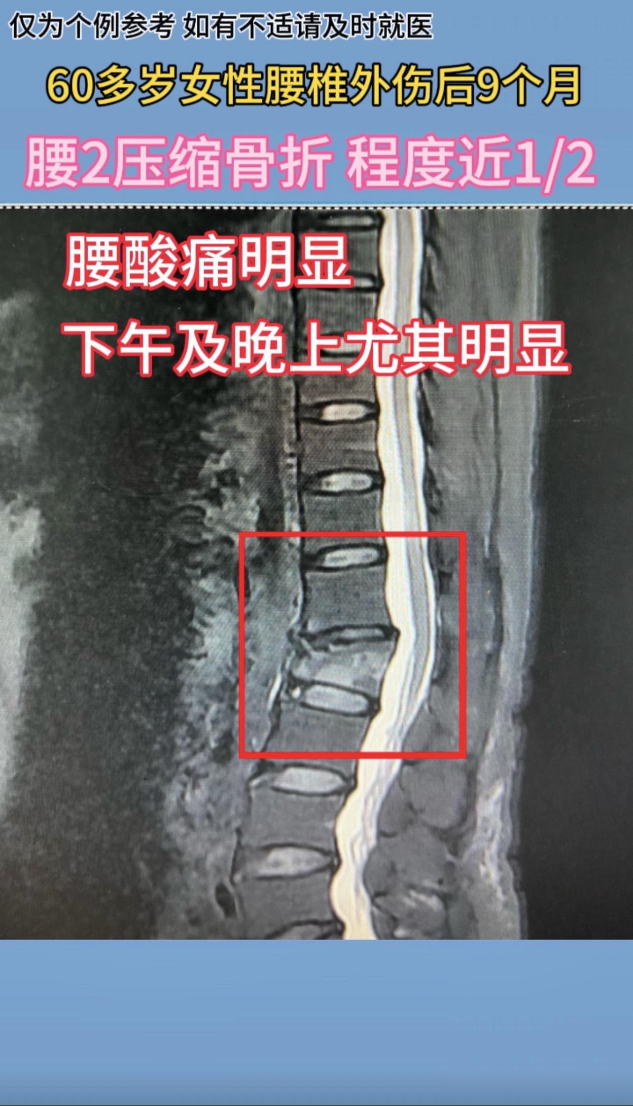 60多岁女性，腰椎外伤后9月，当时压缩程度接近1/2，未做手术。现恢复欠佳，腰酸痛明显，晨轻下午及晚上加重。
刚哥提醒：腰椎压缩骨折如超过1/2，建议手术治疗。