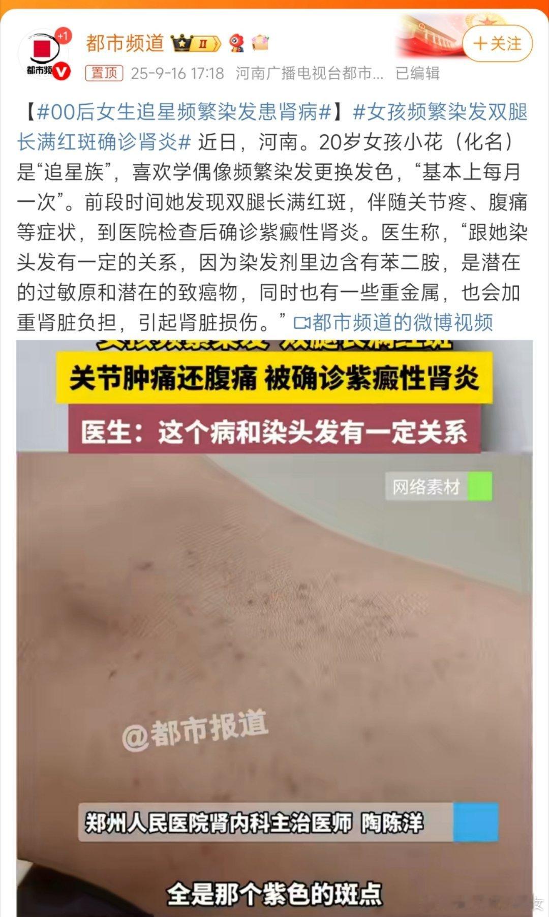 00后女生追星频繁染发患肾病跟追星有什么关系？那明星天天染发怎么不生病啊？在理发