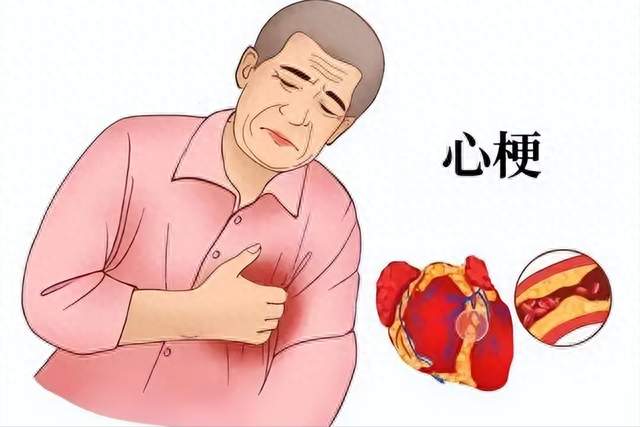 腿部是心梗的提示器？提醒：若腿部出现这 5 种表现，尽快就医