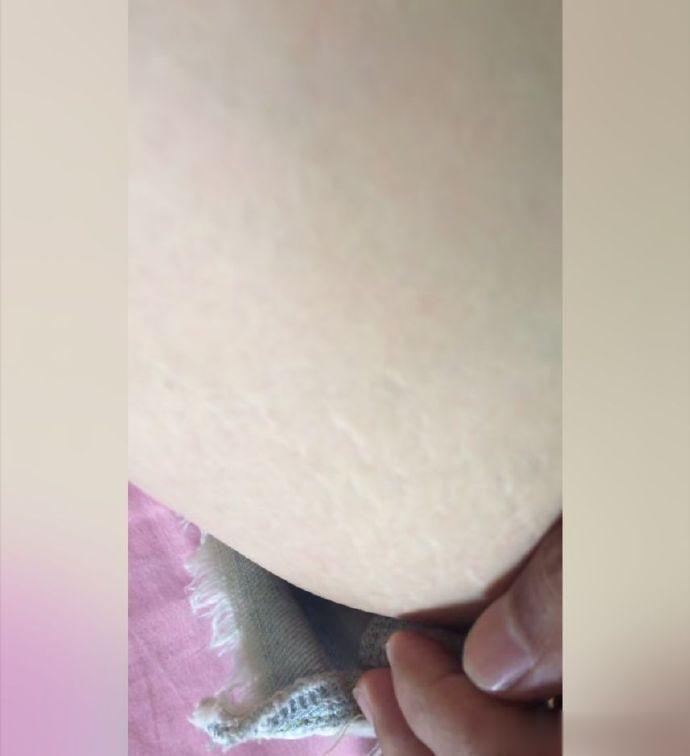 网友:本人93年，找了个女朋友，她说这是遗传的皮肤病。我也不太懂啊！求教各位网友