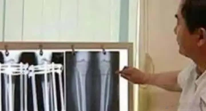 2014年，20岁北京男孩花费16万做了早已被禁止的断骨增高手术，成功长高7.2