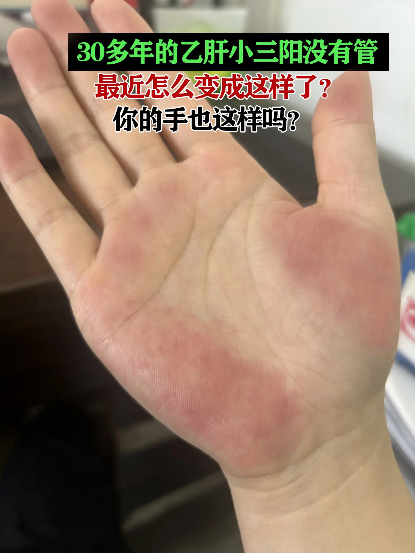 大家快来看，这是典型的肝掌。 常出现在慢性肝病患者身上，表现为手掌大小...
