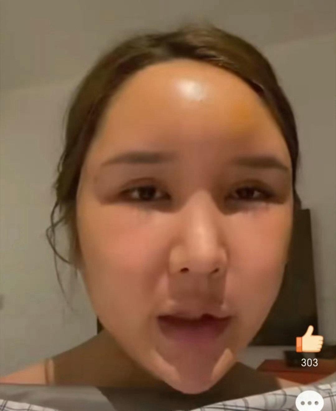 女子注射400只玻尿酸，结果肿胀成了这样，看着实在吓人。
爱美之心可以理解，高科