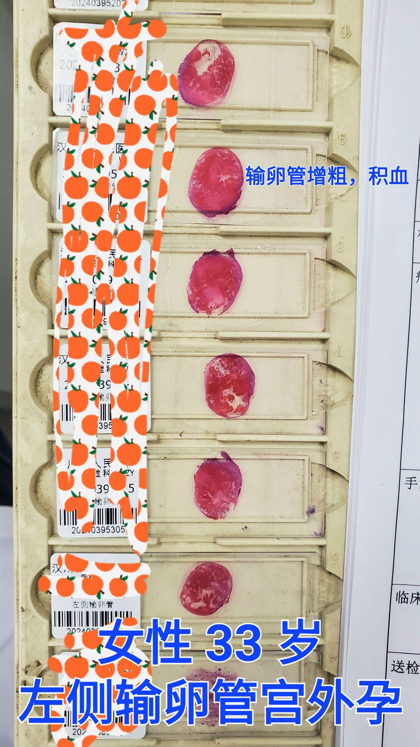 输卵管妊娠