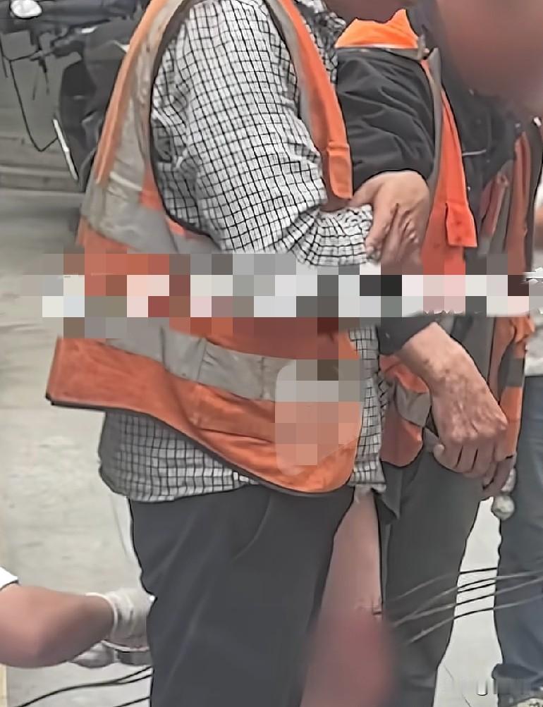 近日，陕西安康，一男子在工地干活，大腿不慎被6根钢筋贯穿，经过医护人员消毒处理后