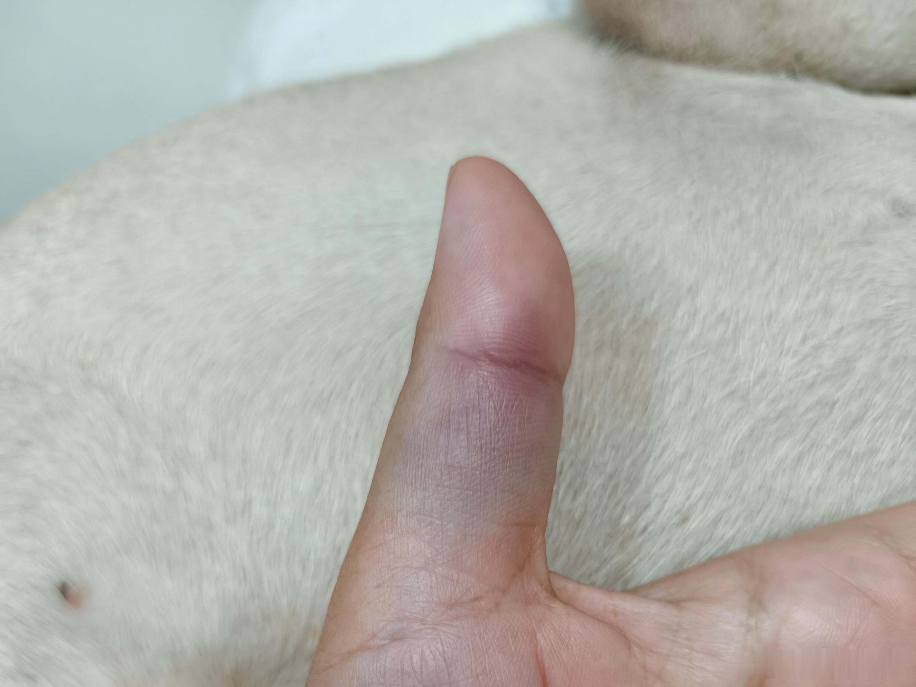 离谱的，左手打在右手上，肿了，整一大片淤青。 