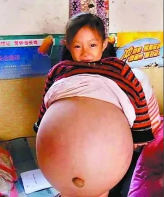 山西一4岁小女孩，肚子异常鼓胀，大得像足月孕妇。多家医生轮番诊断，残酷预言她活不