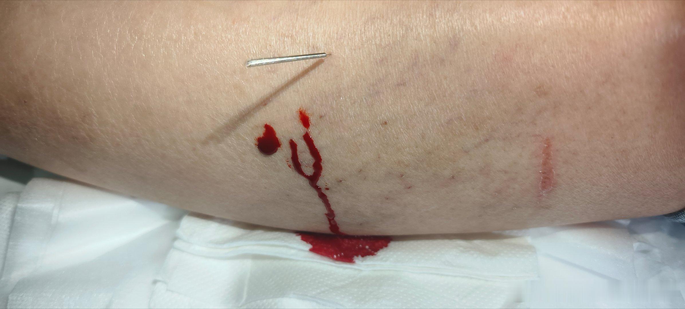 顽固性偏头痛刺络放血，效果不错偏头痛