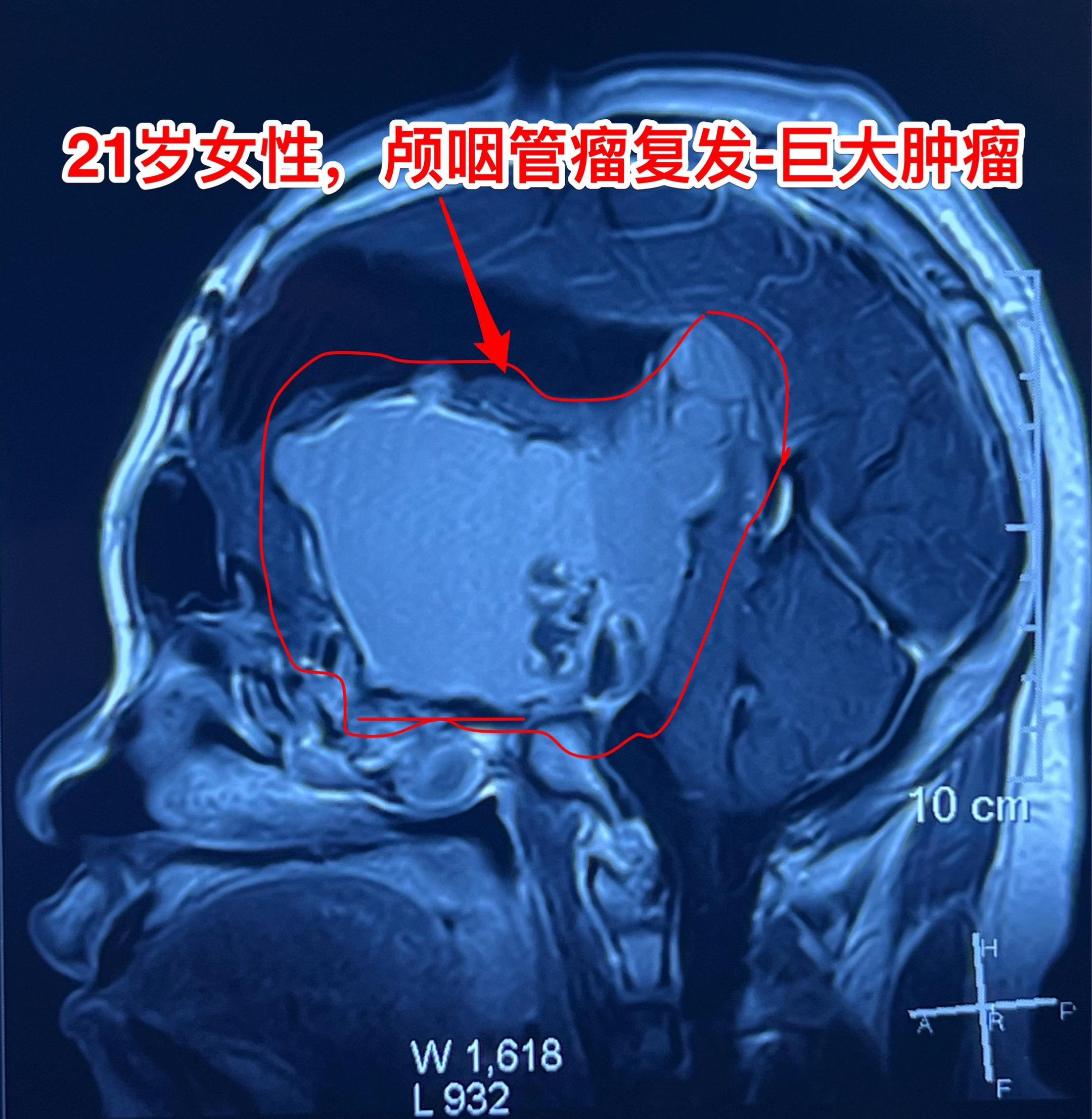 颅咽管瘤体积巨大-不要放弃。21岁女性，颅咽管瘤复发，体积巨大。   ...