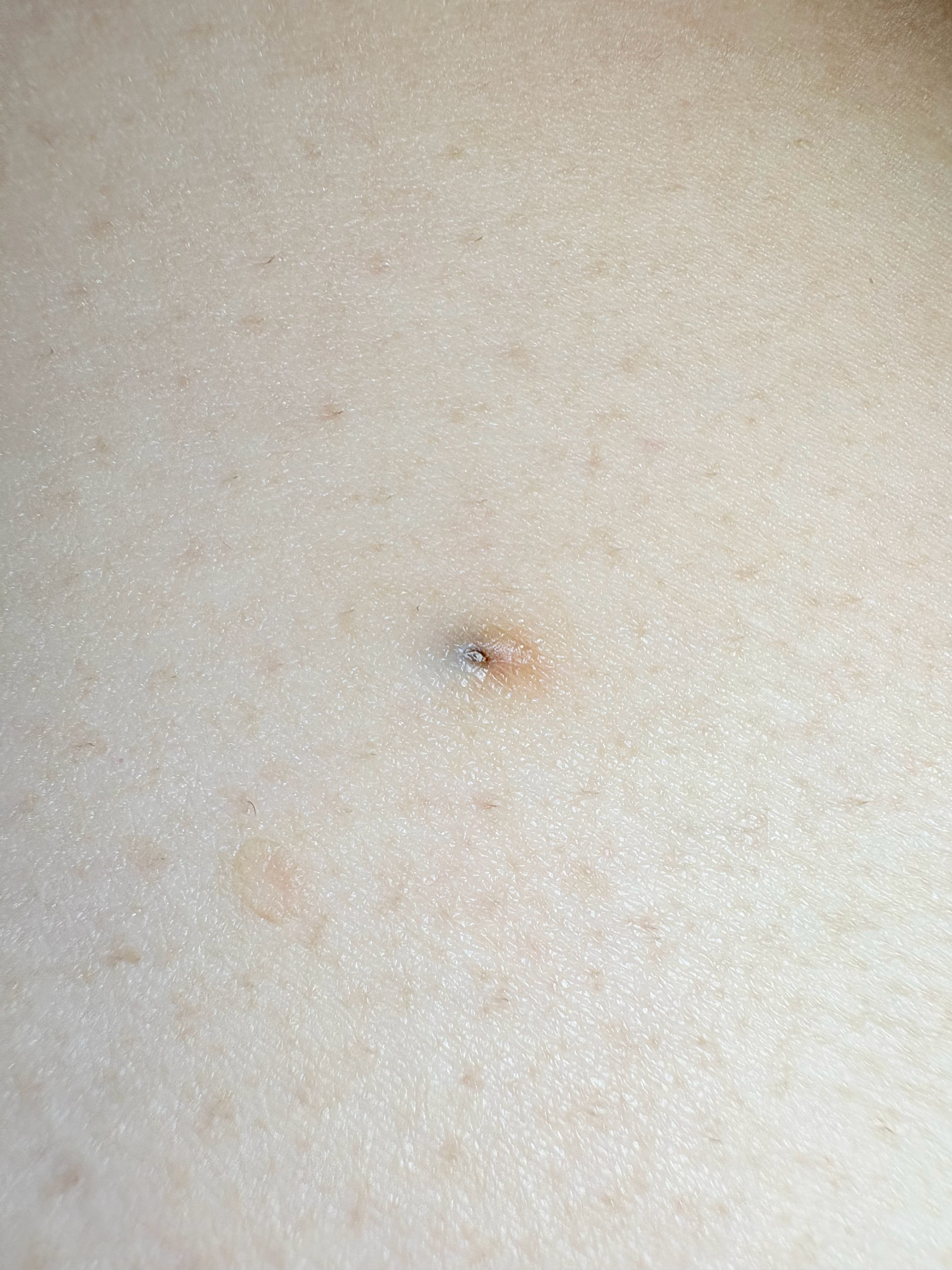 微距摄影作品《男性大腿上的黑头》 ​​​