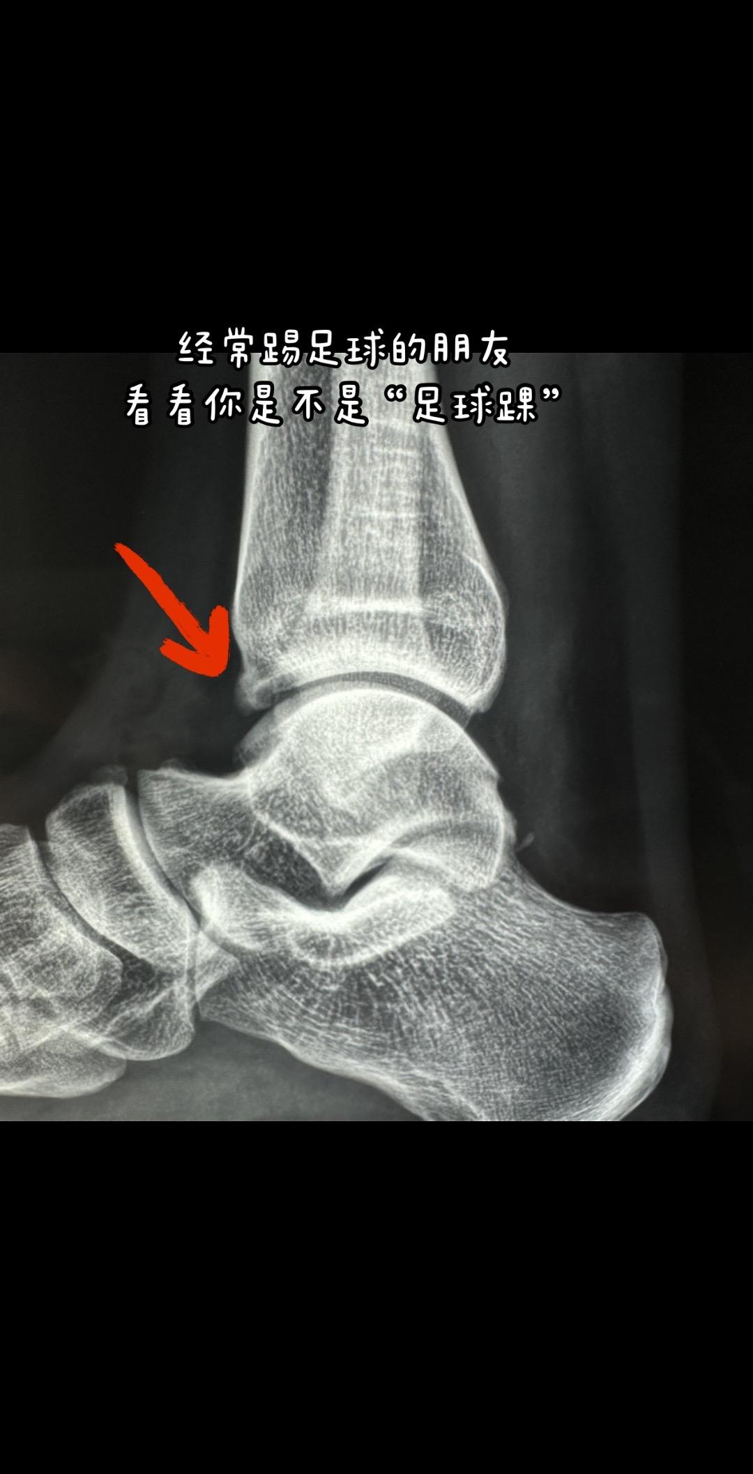 经常踢球的朋友 警惕足球踝。什么是足球踝