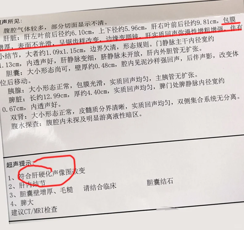 医生：我是肝硬化了吗？还能逆转吗？