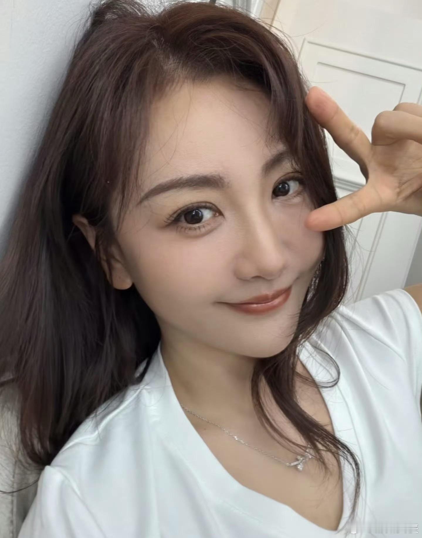 杨蓉面部烫伤恢复近照才知道姐姐被烫伤了，感觉恢复的非常好