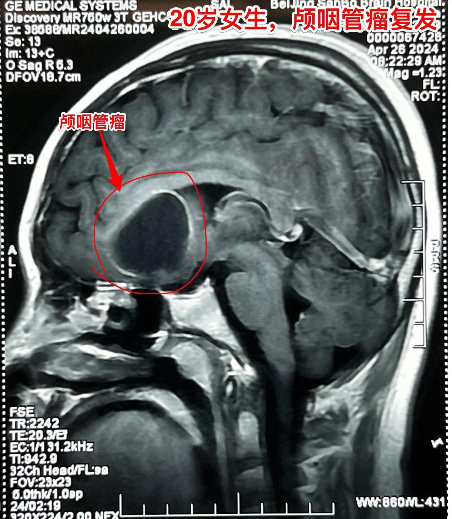 20岁女生，颅咽管瘤两次复发。菏泽女大学生，患颅咽管瘤将近十五年。第一次开颅手术，第二次经鼻手术。病人右眼视力比较差，经过激素替代治疗，看起来还很健康，能上大学正常读书。这次发现两个病灶，一个是囊，嵌入右侧额叶脑实质中；另一个是大钙化，像块石头，长在垂体窝里。这样的复发颅咽管瘤适合开颅手术。
        4月30日作了开颅手术，将两块肿瘤均切除了。术前有些担忧脑脊液鼻漏，术后并没有出现。