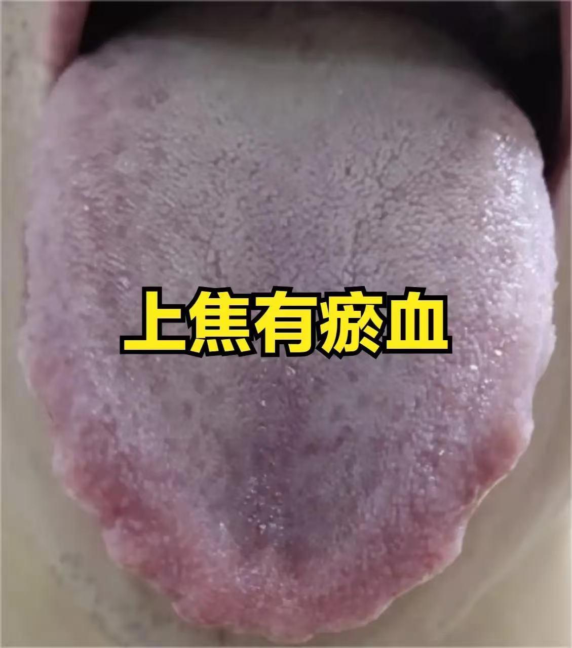 桂枝茯苓丸的 3 个黄金搭配，瘀血从上到下一扫而空


①桂枝茯苓丸 + 血府逐