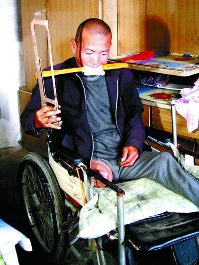 2012年，河北一农民双腿因动脉血栓，腐烂生蛆，没钱医治又疼痛难忍的他，拿起锯子
