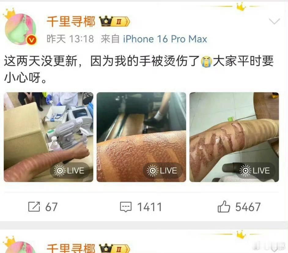 千里寻椰 光子嫩肤二度烧伤我的老天爷啊……小图都只敢眯着眼看的程度……一直不敢z
