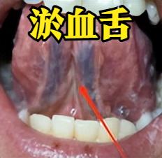 一、舌象 + 症状：一眼辨 “气滞血瘀”（不是单纯血瘀！）
想分清自己是单纯血瘀