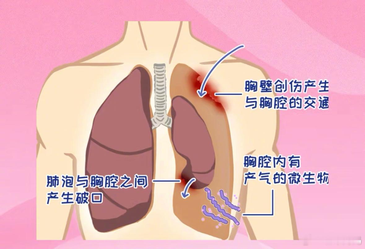 气胸  方大同去世  其实好多歌手、配音演员都得过气胸，也算一种潜在职业病了吧[