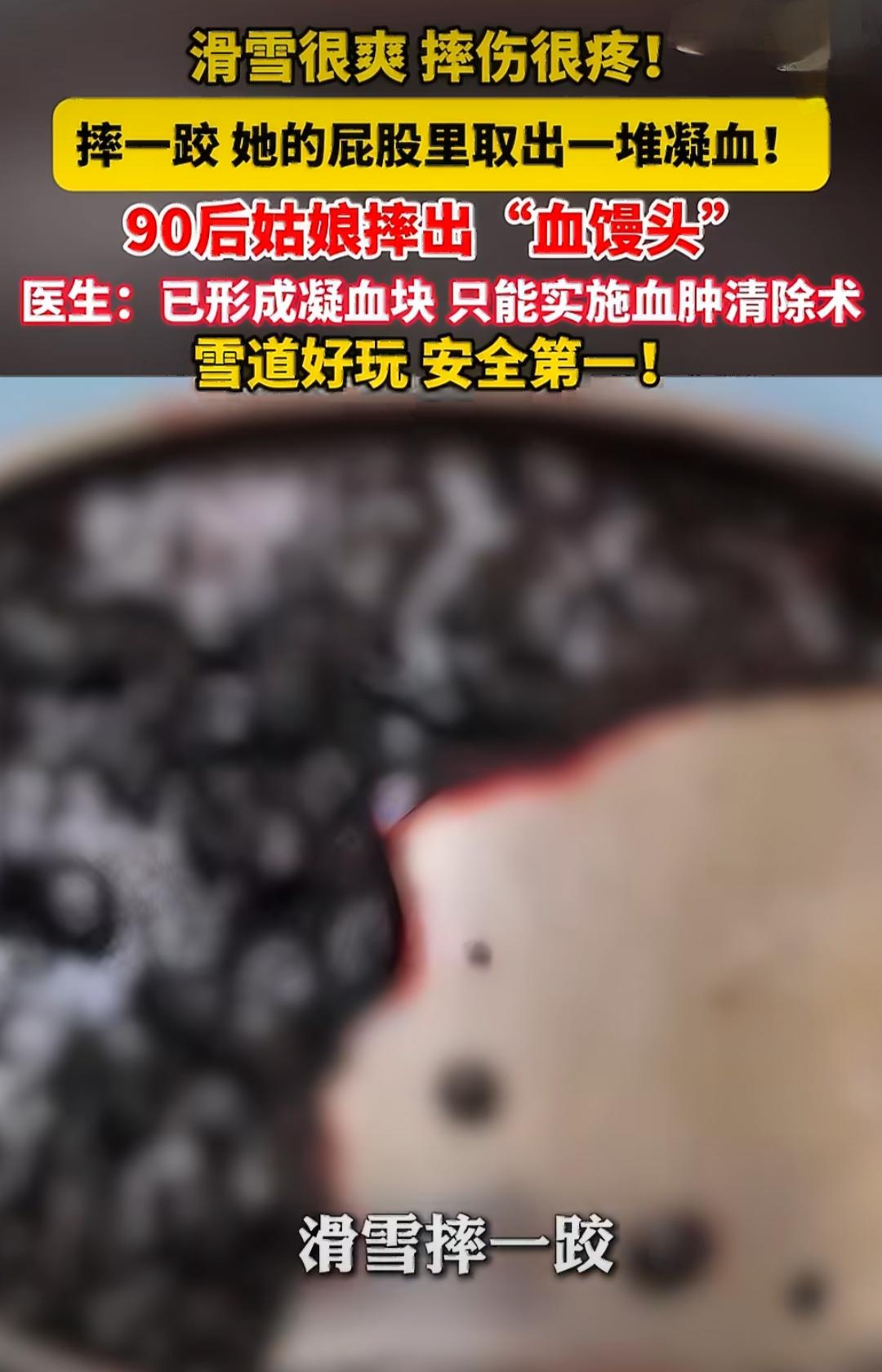 浙江杭州一位90后女生小江滑雪时遭遇意外摔伤，后续臀部出现严重血肿，到医院做手术