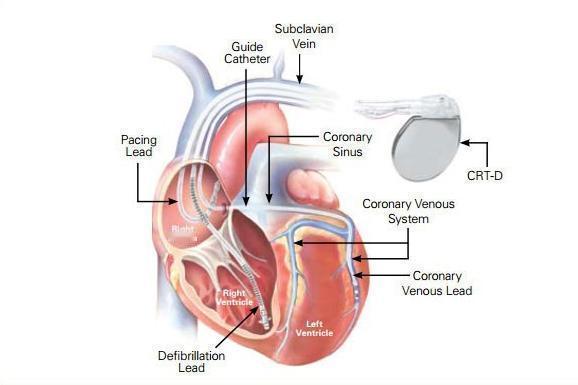 62岁阿姨反复晕倒，心脏只剩1/3功能！假期结束第一天上班，说说这样一台特殊的手