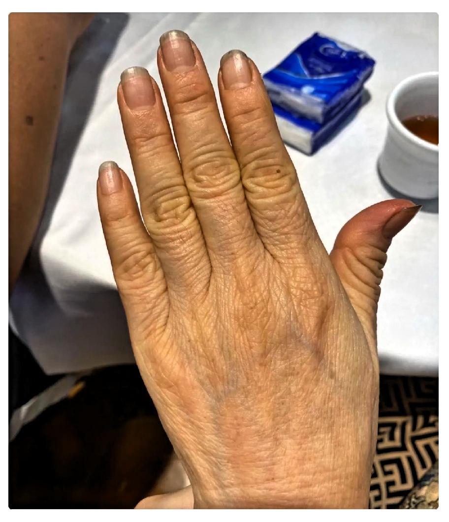 我右手麻了快六年，一直以为是颈椎病。上个月陪老伴去拿体检报告，医生顺嘴问了一句话