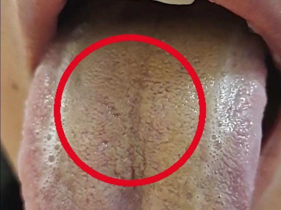 湿热在身体哪里？舌头都能反映出来，别再乱吃清湿热药了
 
 
脾胃湿热的人，舌苔