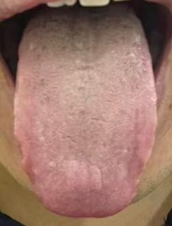 肝气不舒兼肝胆湿热，气机阻滞则宗筋失养







不少朋友年纪轻轻就被身体问