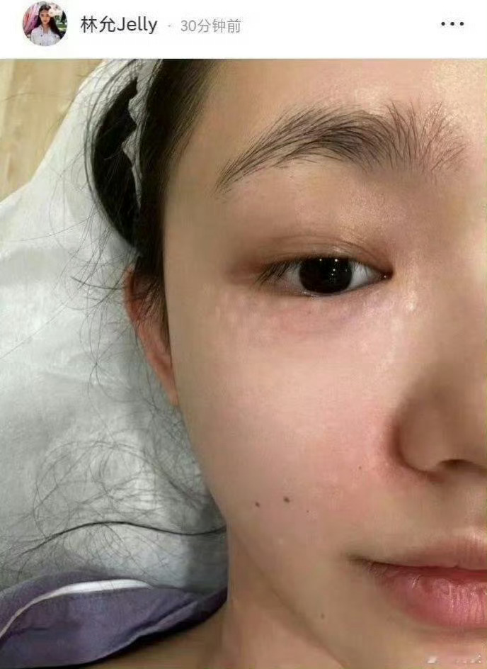 林允27岁开始打胶原蛋白，脸上针孔密布。年纪轻轻就如此焦虑… 
