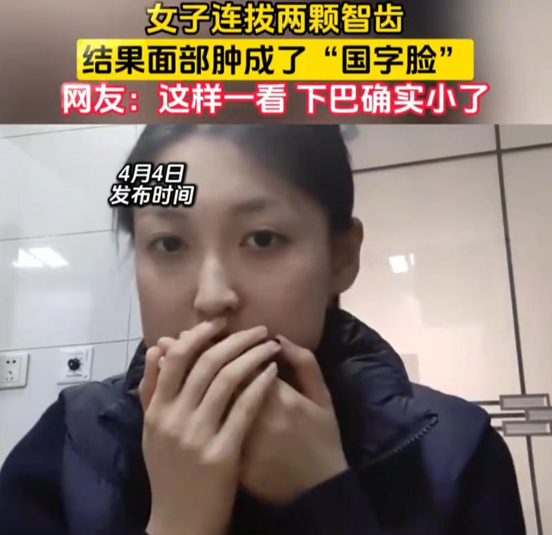 这是个狠人！女子趁着假期，连拔了两颗智齿，没成想，拔完以后肿的脸型都变了，以前是